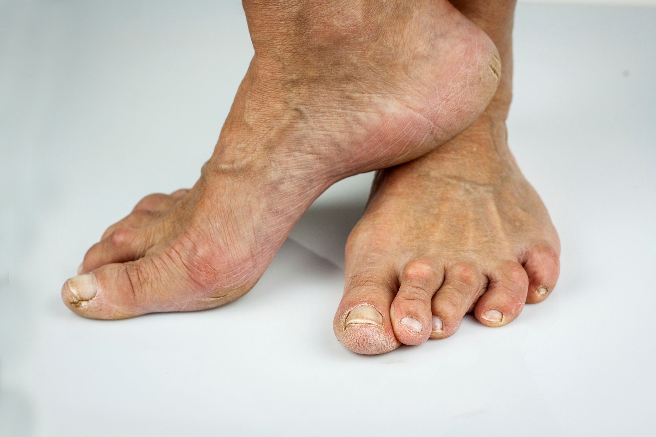 Ageing Feet