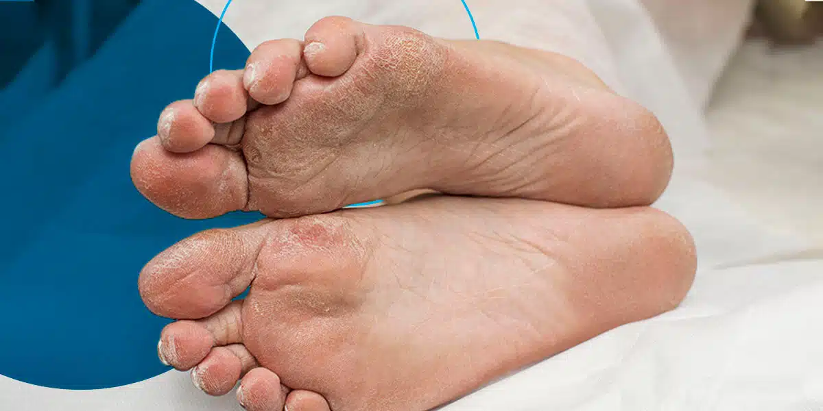 Diabetic Feet