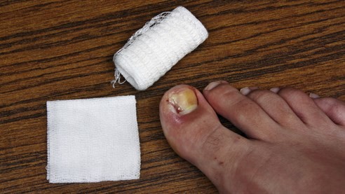 Ingrowing Toenail